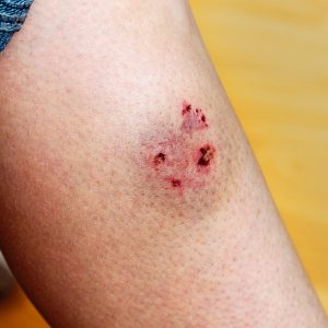 Woman's leg injured by a dog bite